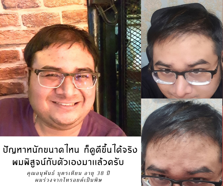 รีวิวผลลัพธ์หลังใช้เซรั่มปลูกผม