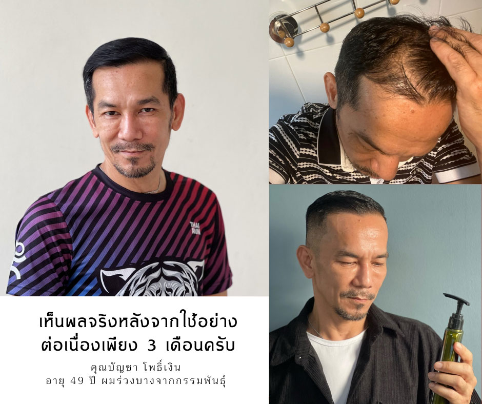 รีวิวผลลัพธ์หลังใช้ยาสระผมแก้ผมร่วง