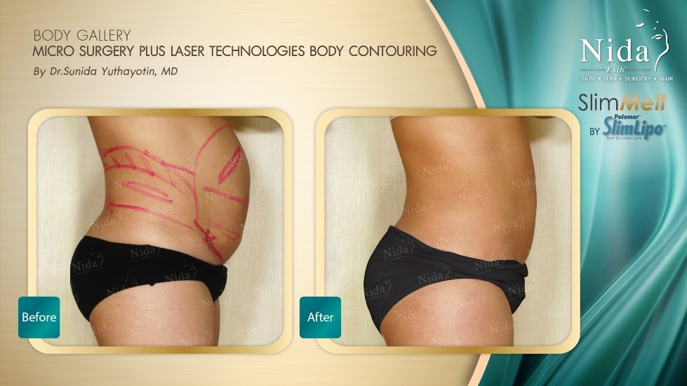 Nida Esthetic Cosmetic Surgery Bangkok