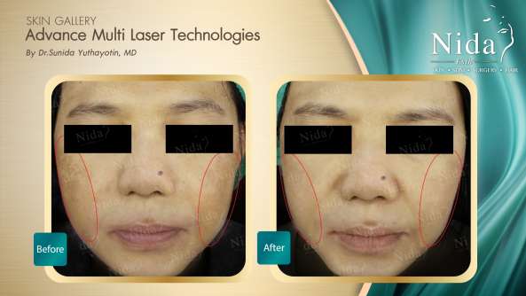 Nida Esthetic Cosmetic Surgery Bangkok