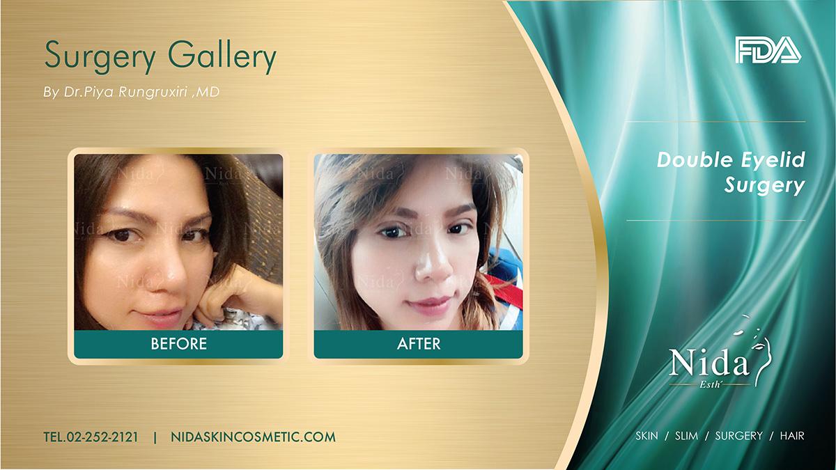 Nida Esthetic Cosmetic Surgery Bangkok