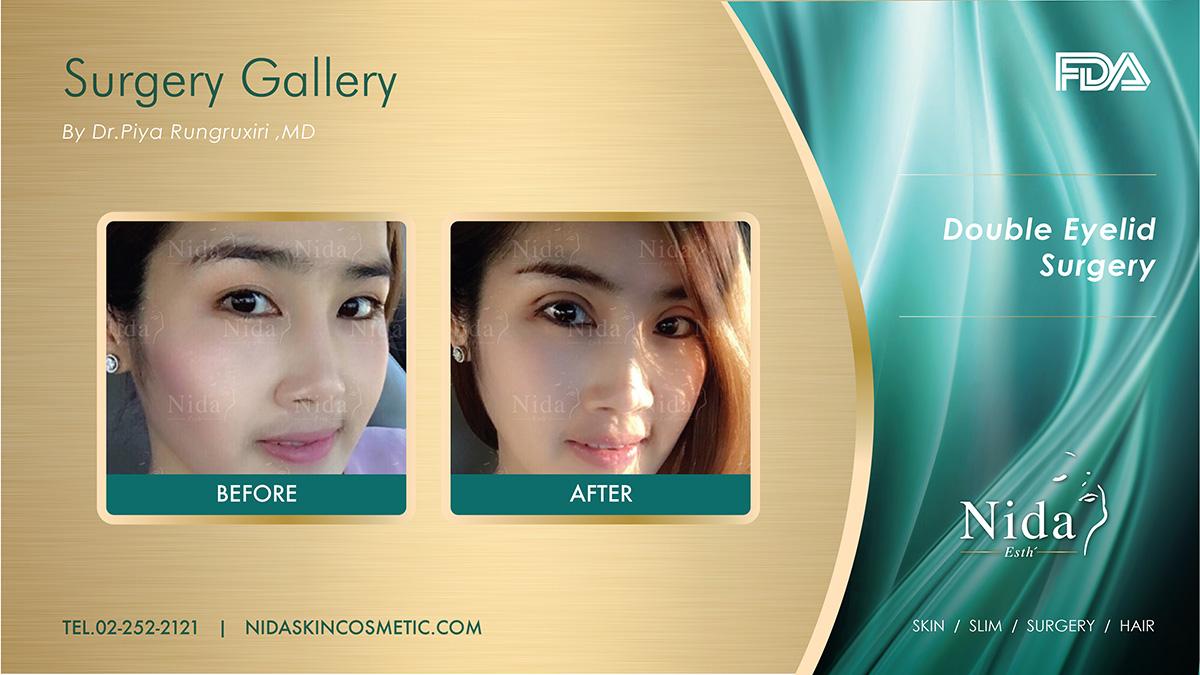 Nida Esthetic Cosmetic Surgery Bangkok