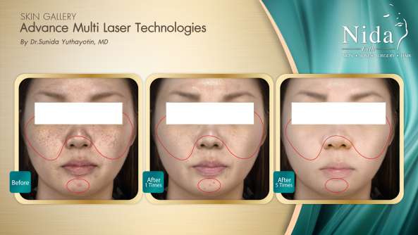 Nida Esthetic Cosmetic Surgery Bangkok