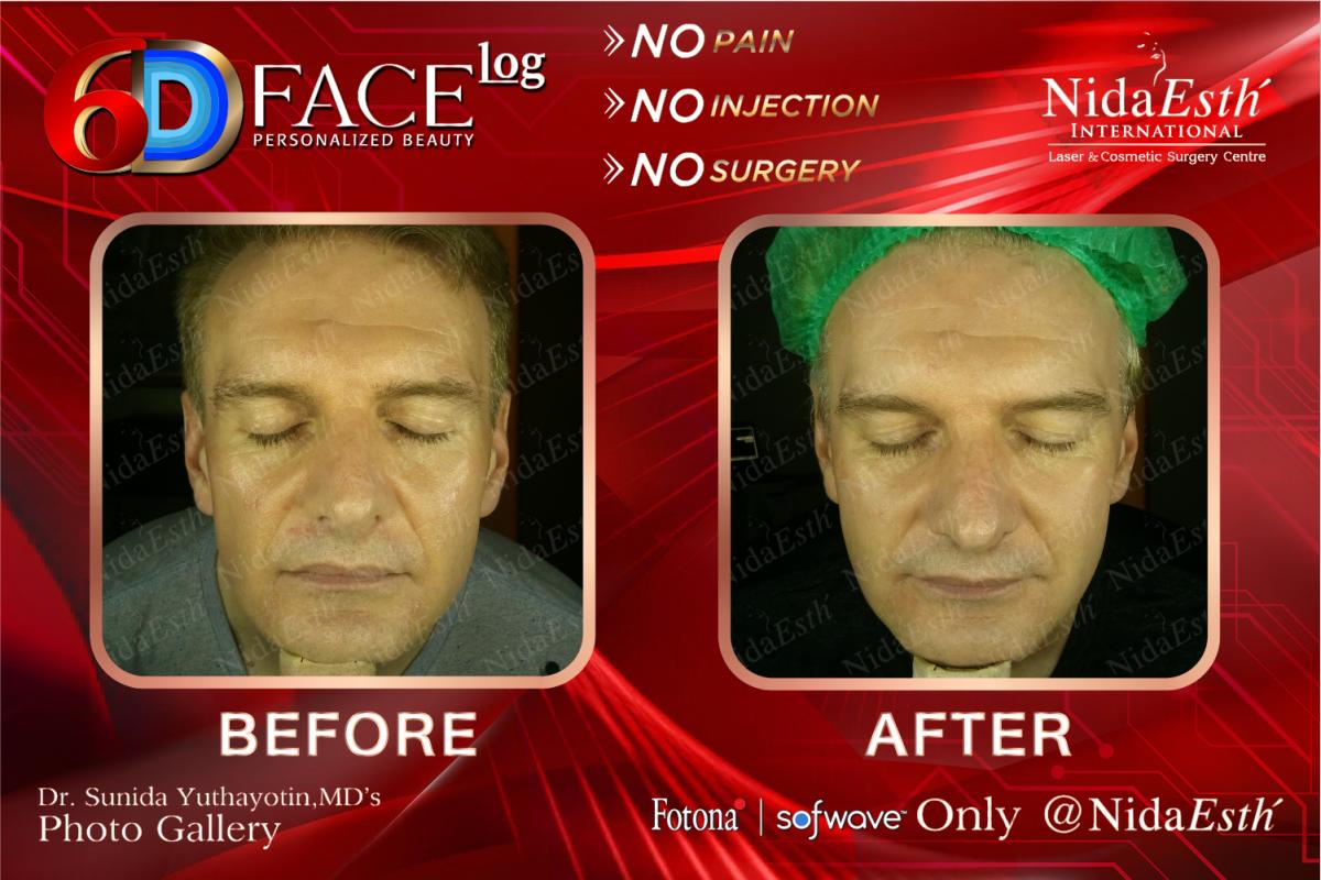 Before After