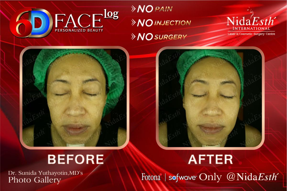 Before After