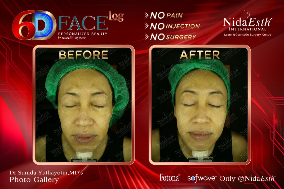 6D face Log before After