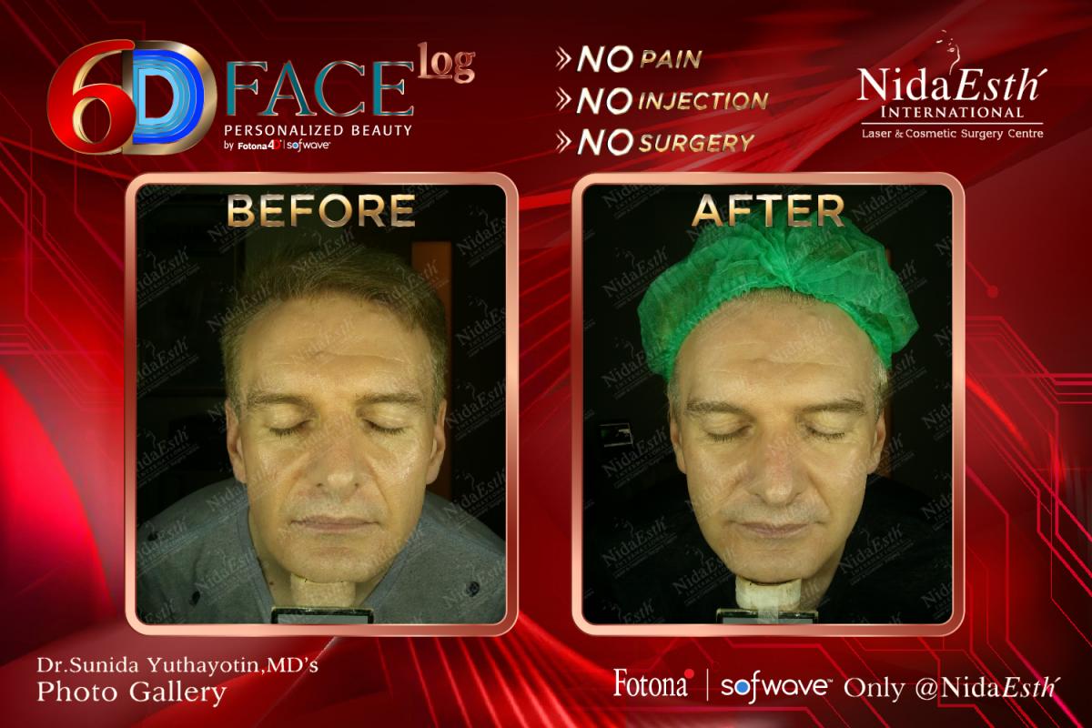 6D face Log before After