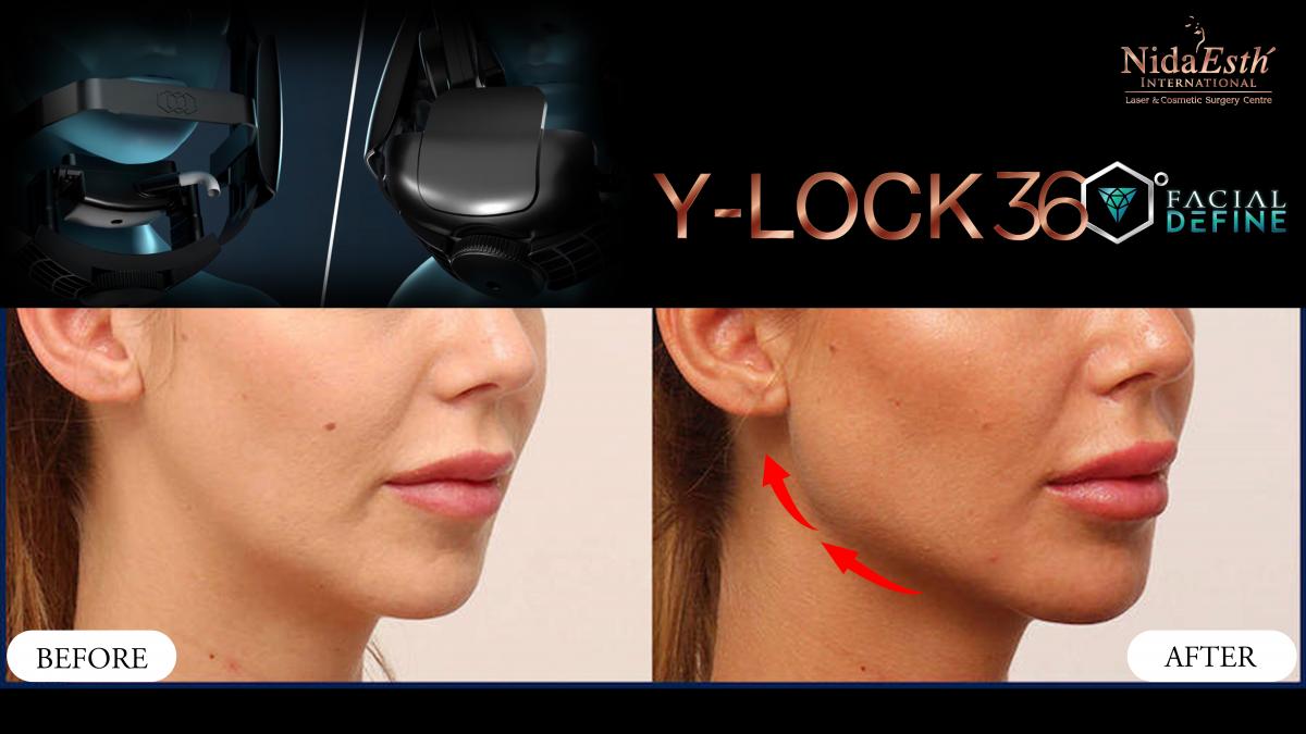 Y Lock 360 Facial Define Before After