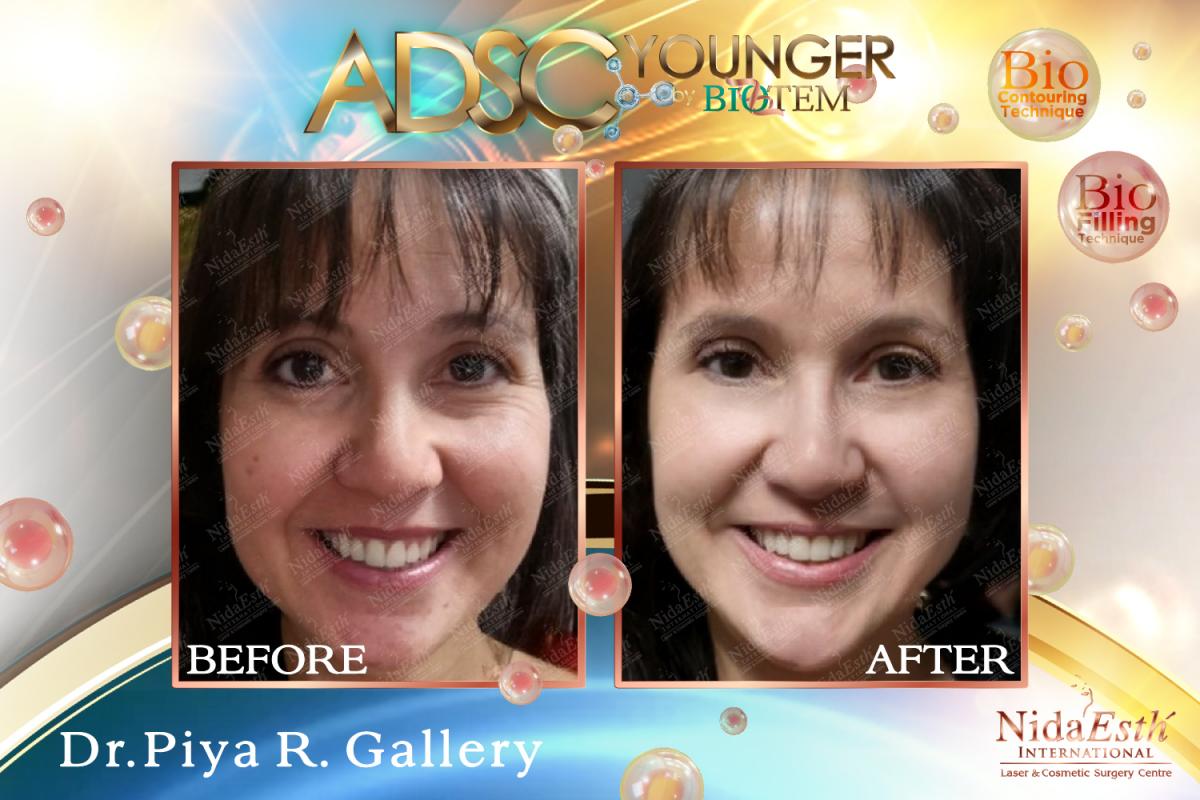 ADSC Younger Before After