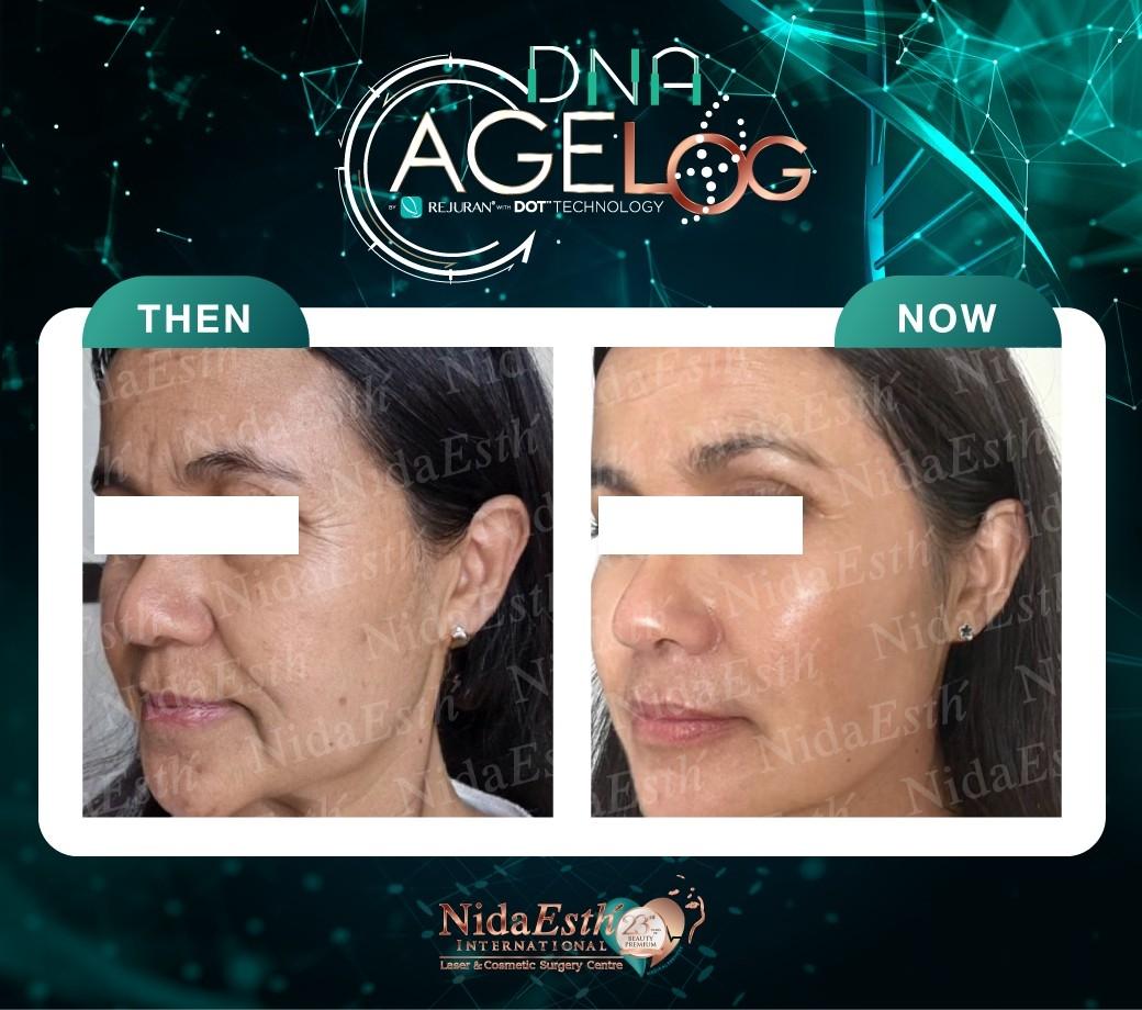 DNA Age LOG before After