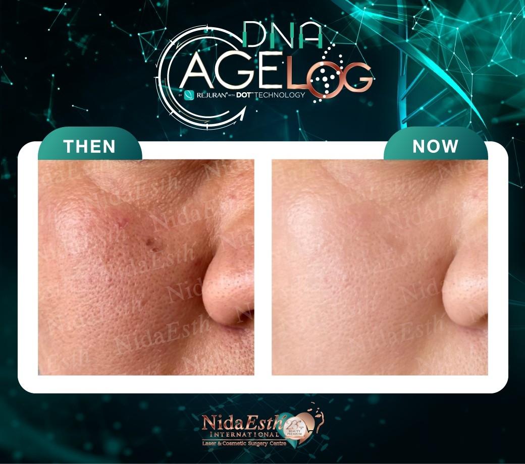 DNA Age LOG before After
