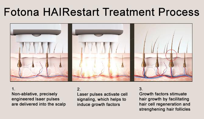 How does it work Fotona 4D Hair Regrowth