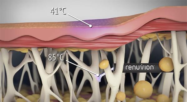 How does it work of J-Plasma