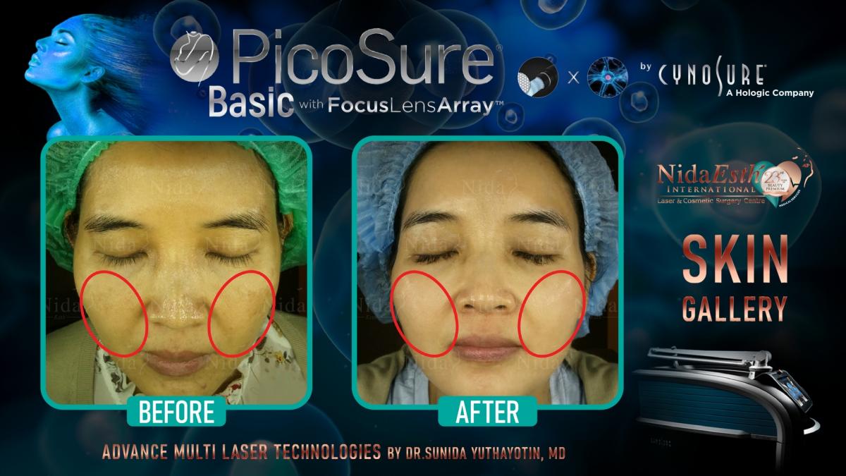 PicoSure Logo