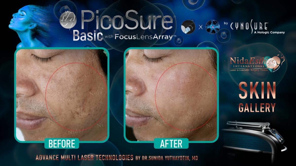 PicoSure before after
