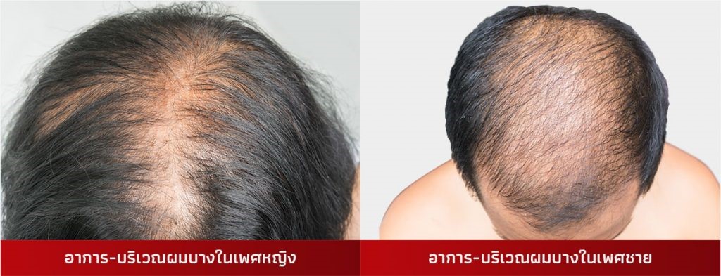 อาการผมบางทั้งหญิงและชายแก้ได้ด้วยผลิตภัณฑ์แชมพูแก้ผมร่วง